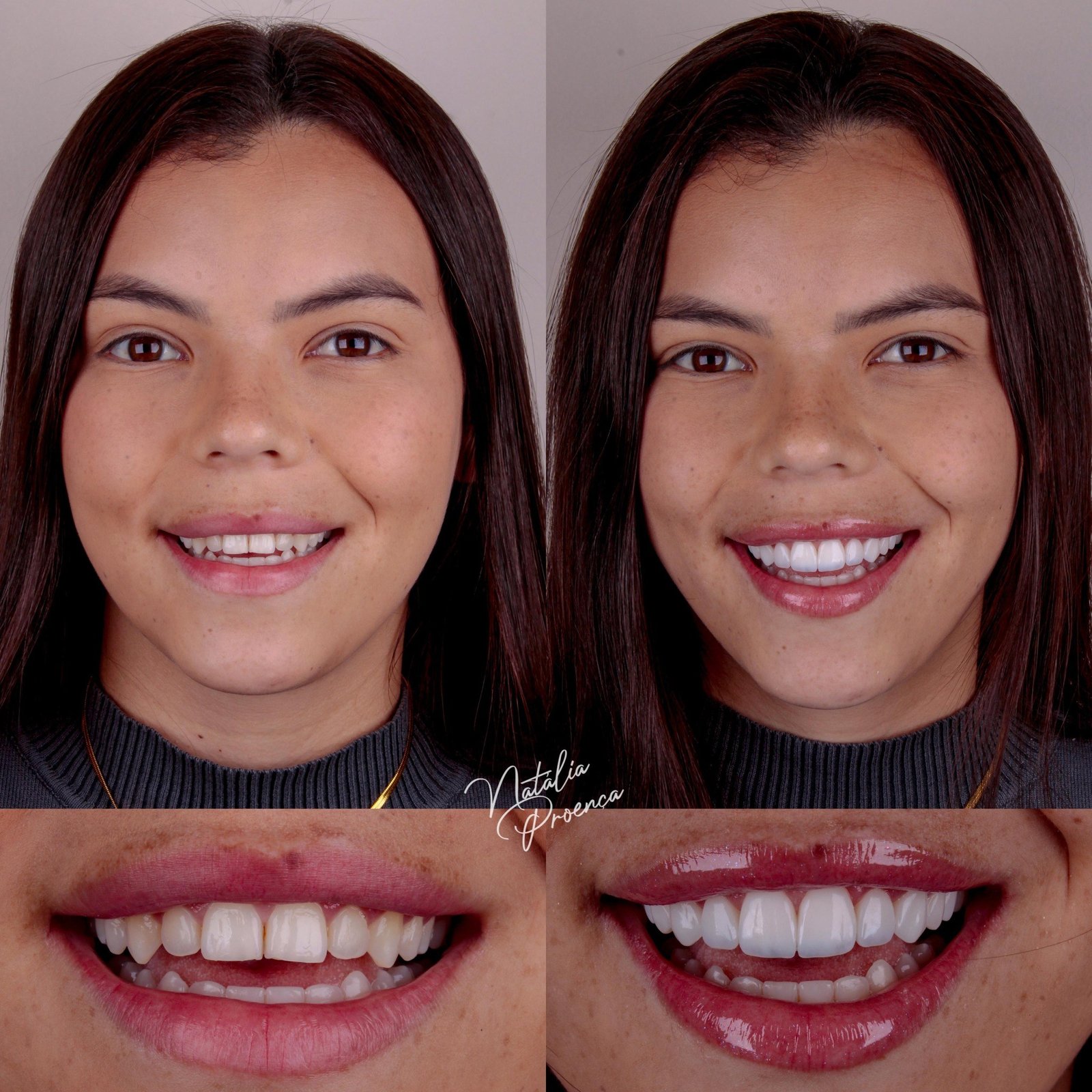 Antes e depois de tratamento estético do sorriso